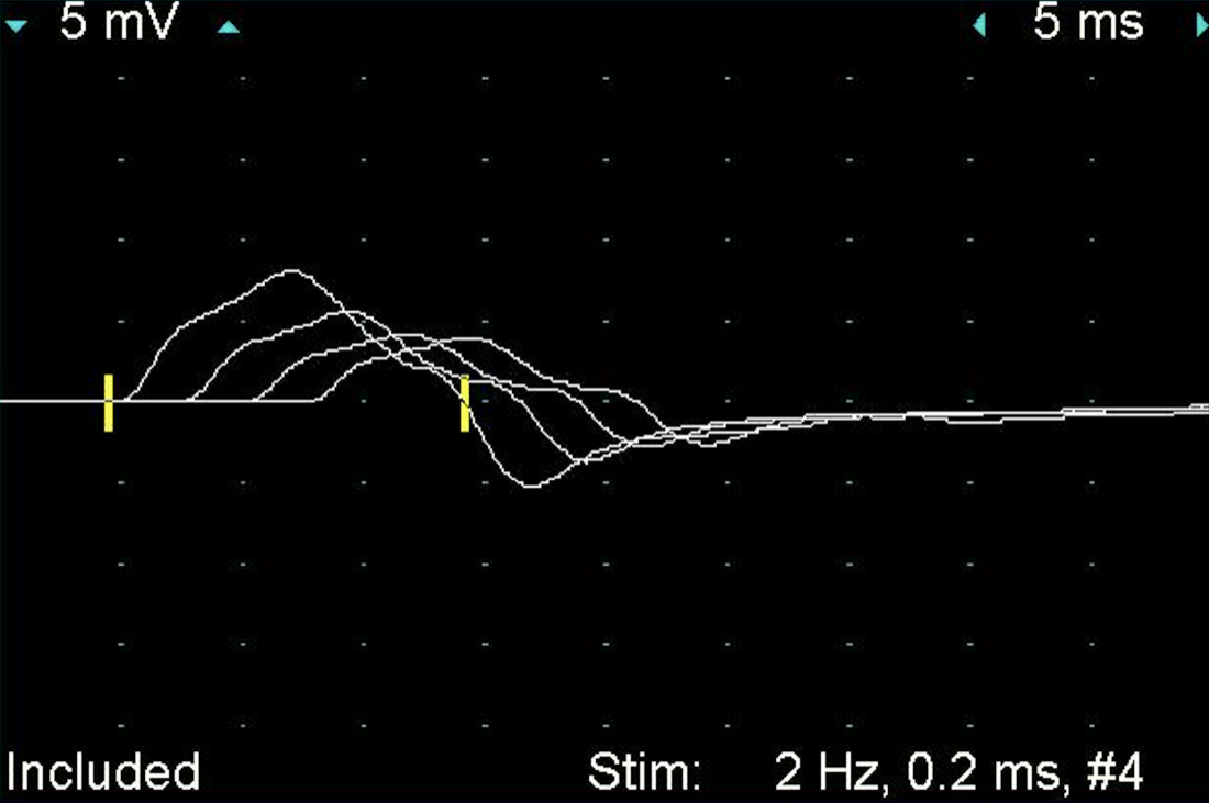 Waveform trace showing decrement on repetitive stimulation testing